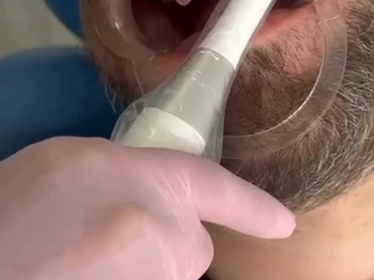 Etapa clínica del tratamiento de carillas sin desgaste